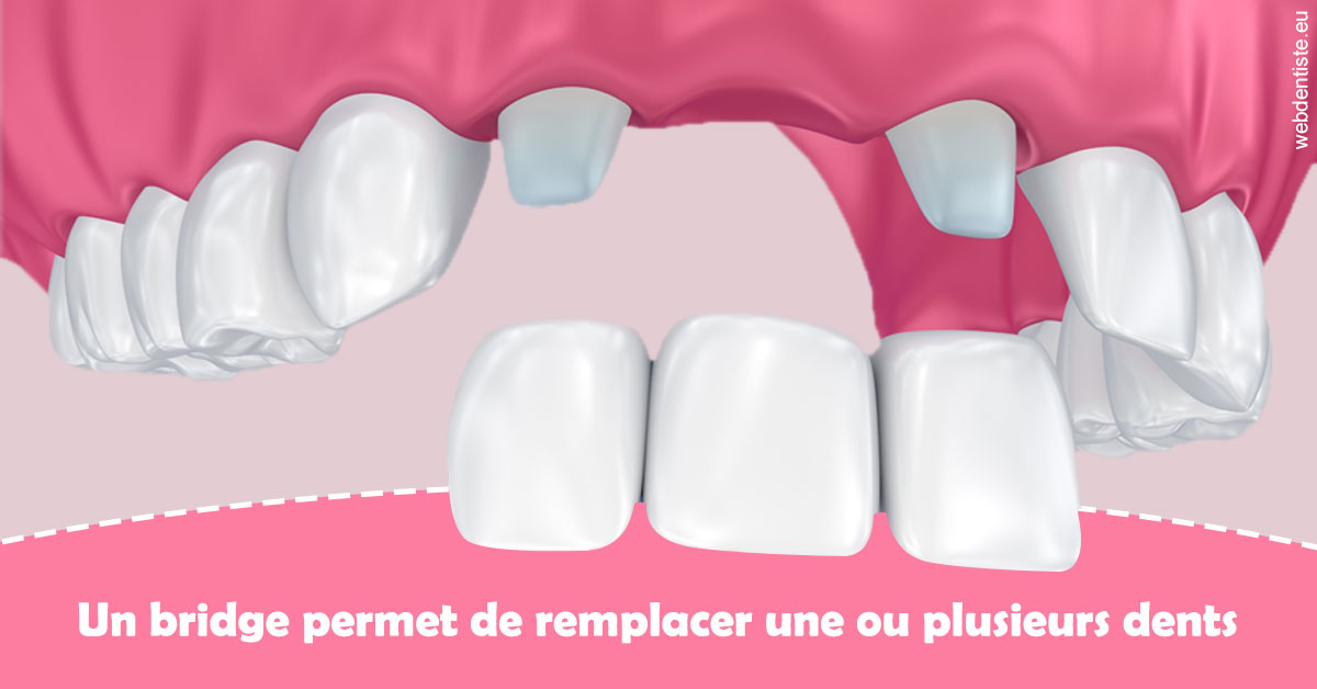 https://dr-halb-luc-joseph.chirurgiens-dentistes.fr/Bridge remplacer dents 2