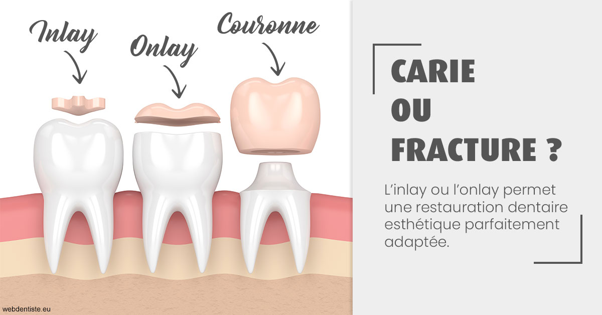 https://dr-halb-luc-joseph.chirurgiens-dentistes.fr/T2 2023 - Carie ou fracture 1
