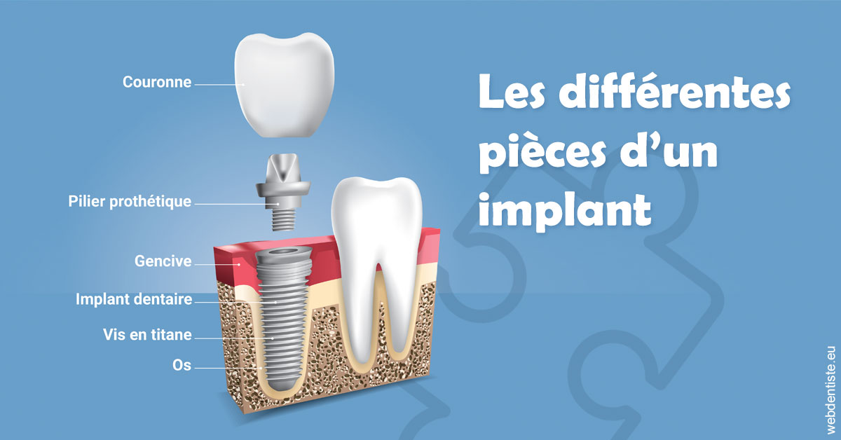 https://dr-halb-luc-joseph.chirurgiens-dentistes.fr/Les différentes pièces d’un implant 1